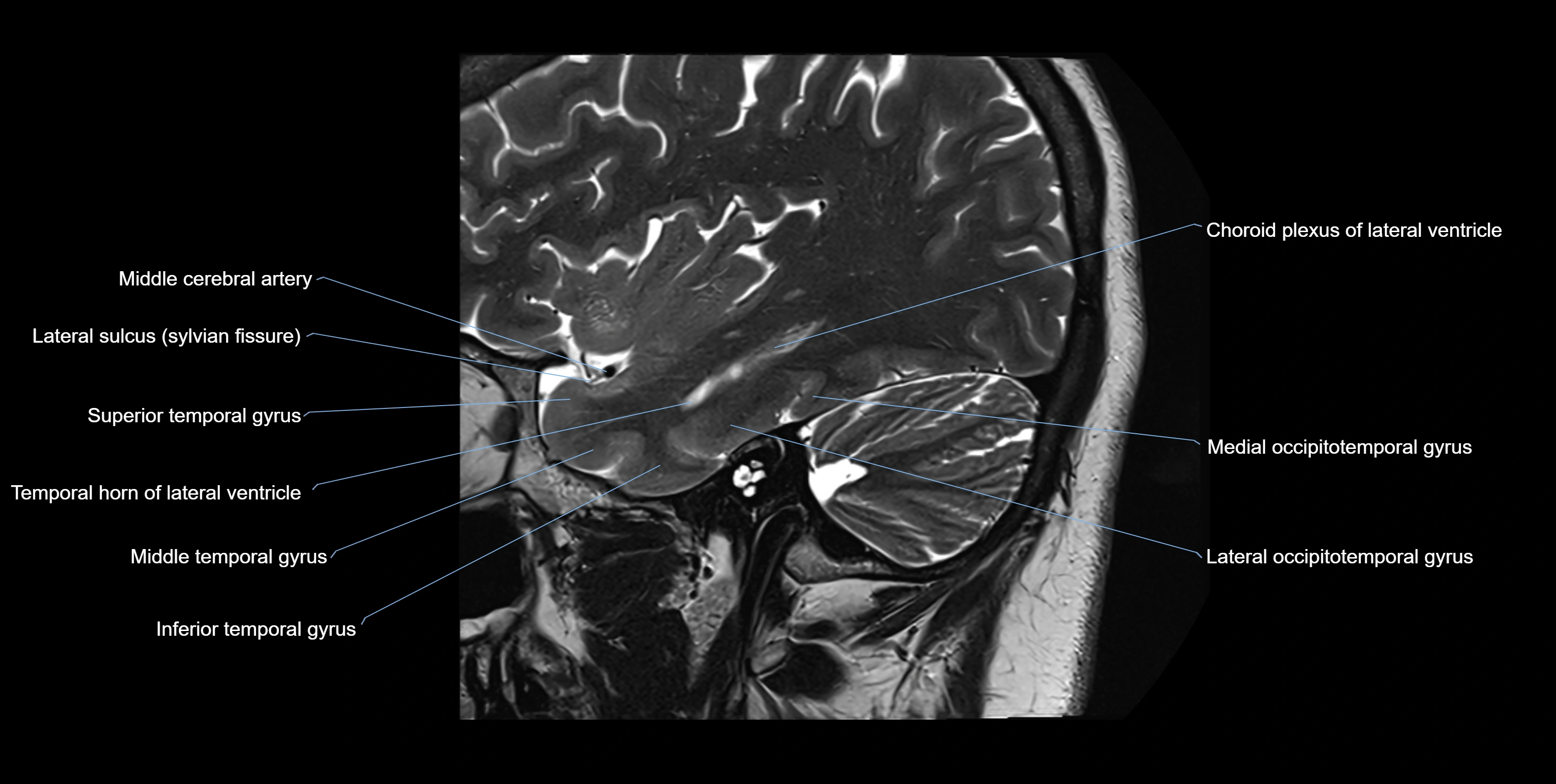 hippocampus sagittal cross sectional anatomy 3T MRI images -img-10002.webp